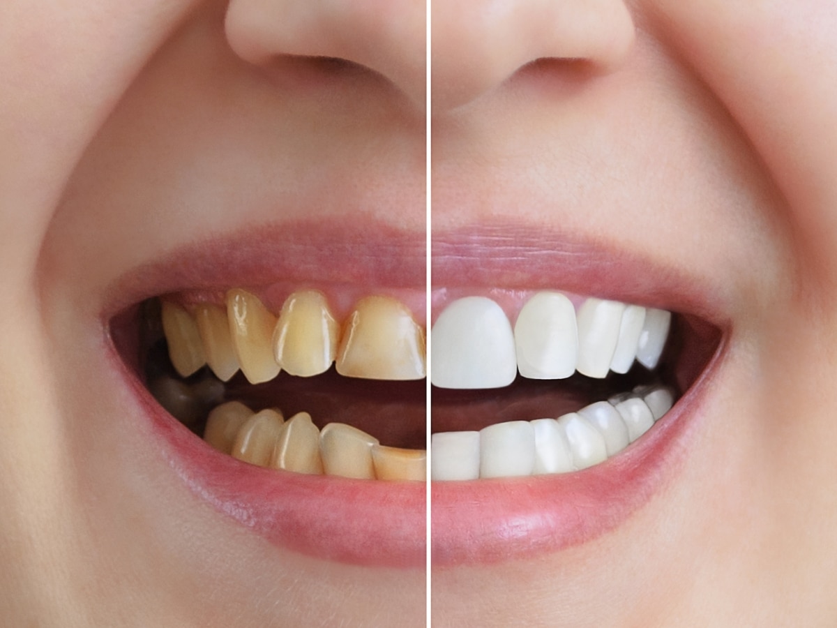 Yellow Teeth Home Remedies: पीले दांतों ने छीन ली है आपकी मुस्कान? नारियल के तेल में ये चीज मिलाकर लगाएं, मोती जैसे हो जाएंगे सफेद