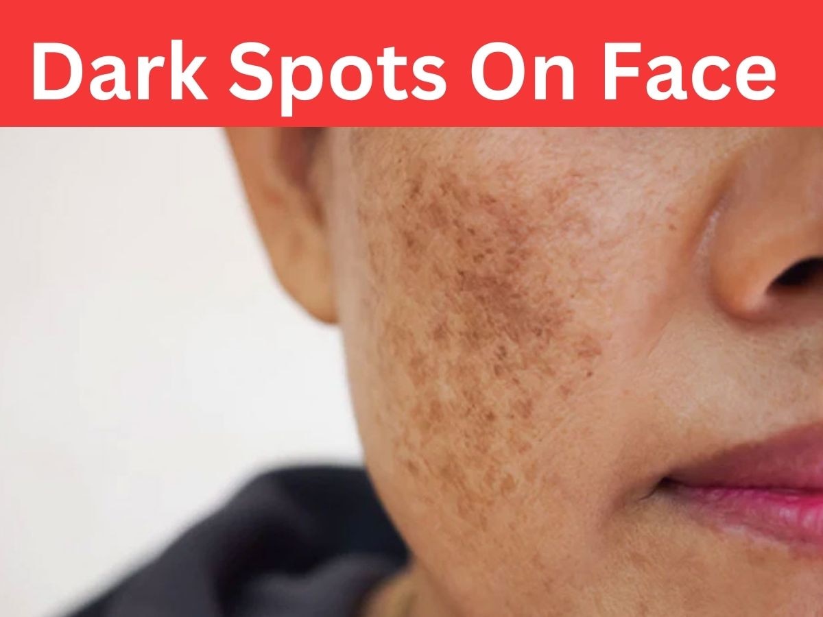 Dark Spots: अगर अब भी नहीं बदलेंगे ये 4 आदतें, तो आते रहेंगे चेहरे पर काले धब्बे