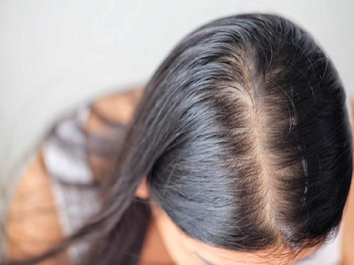 Hairfall Remedies: मानसून में बालों के झड़ने से हैं परेशान तो ये टिप्स आएंगे आपके बेहद काम