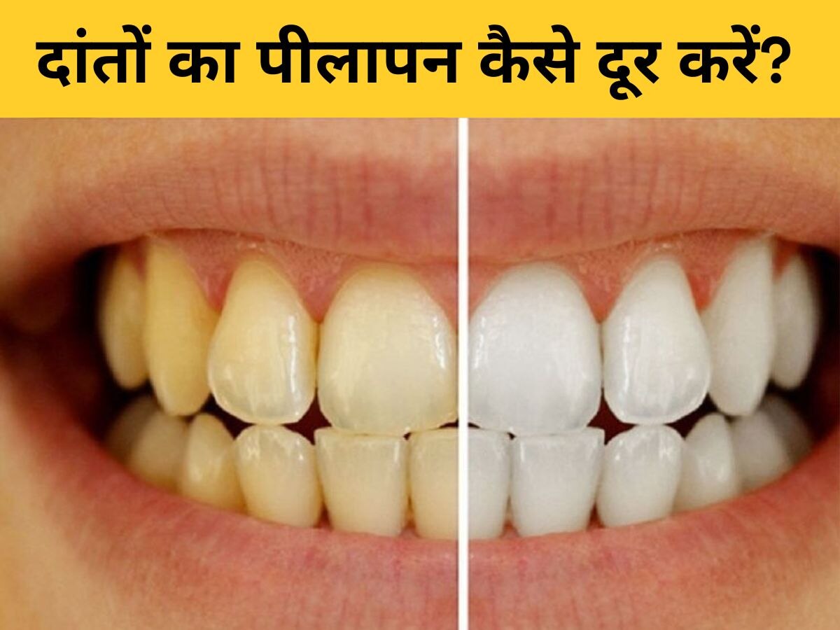 Teeth Whitening: पीले दांतों की वजह से नहीं खिंचा पा रहे क्लोज फोटोज? ऐसे बनाएं इन्हें चांदी जैसा चमकदार