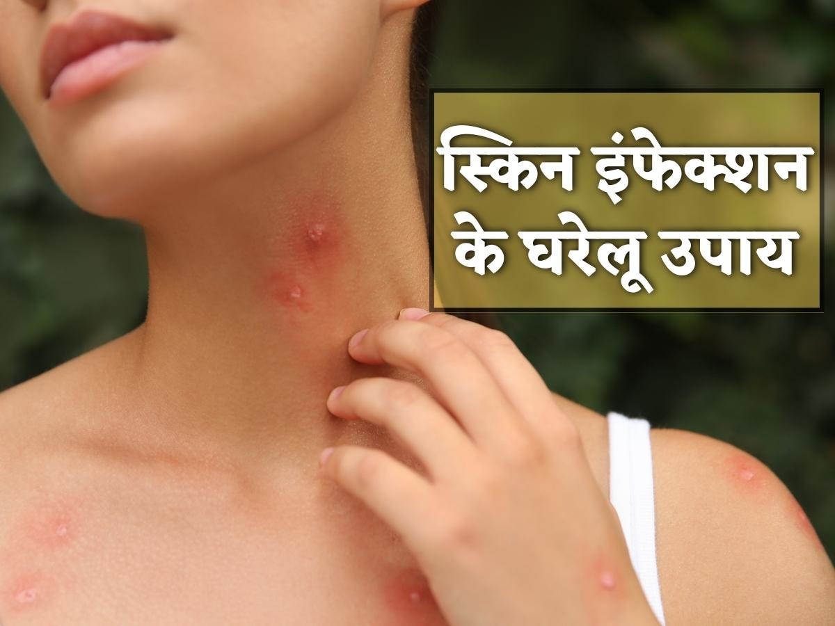 Insect Bite Home Remedies: कीड़े के काटने से स्किन में हो गया है इंफेक्शन? इन घरेलू उपायों से पाएं राहत