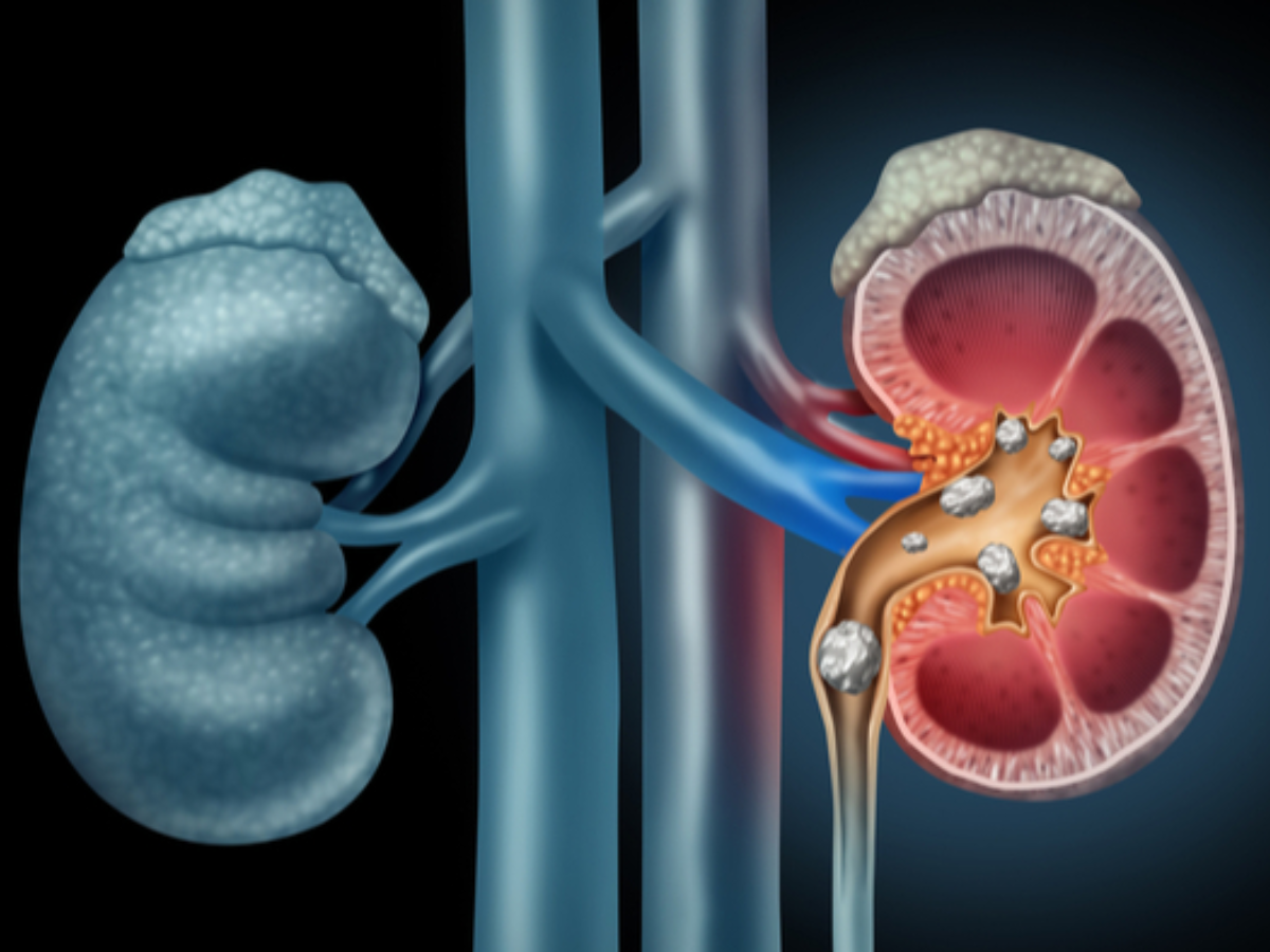 Stone Treatment: इस मशीन से बिना चीर-फाड़ के 1 घंटे में निकल जाएगी पथरी, इस अस्पताल में मिलेगा मुफ्त इलाज Stone Treatment: इस मशीन से बिना चीर-फाड़ के 1 घंटे में निकल जाएगी पथरी, इस अस्पताल में मिलेगा मुफ्त इलाज