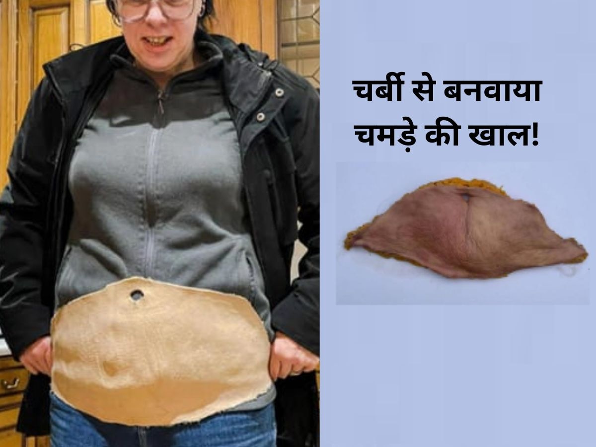Human leather: महिला का अजीब कारनामा, पेट की सर्जरी कराई..चर्बी से बनवाया चमड़े का खाल!