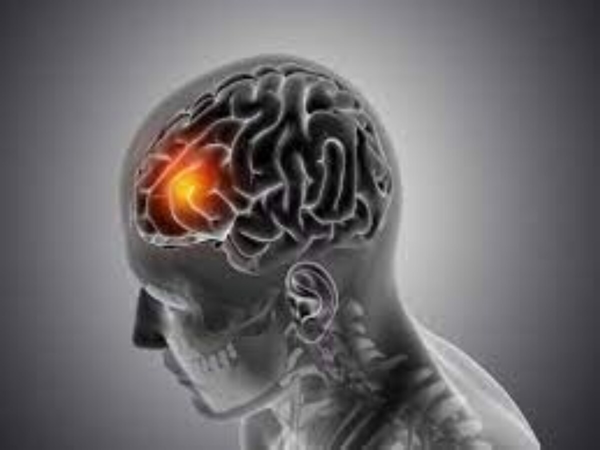 Brain Tumor Symptoms: लगातार सिर दर्द के पीछे जानलेवा बीमारी तो नहीं,  जानें कैसे समय रहते करें ब्रेन ट्यूमर से बचाव