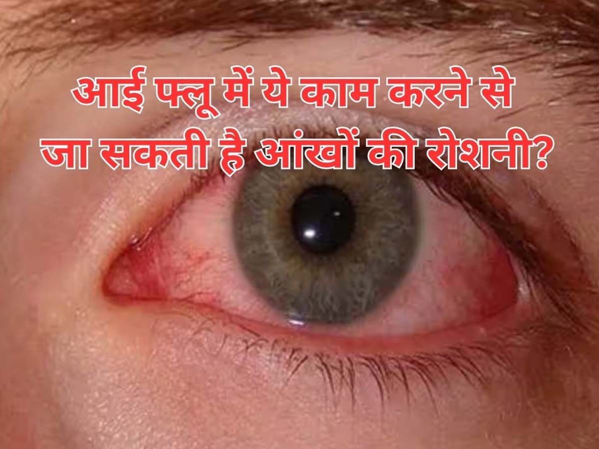 Eye Flu Causes Treatment and Home Remedies How to avoid eye flu Eye Flu Remedies आई फ्लू में