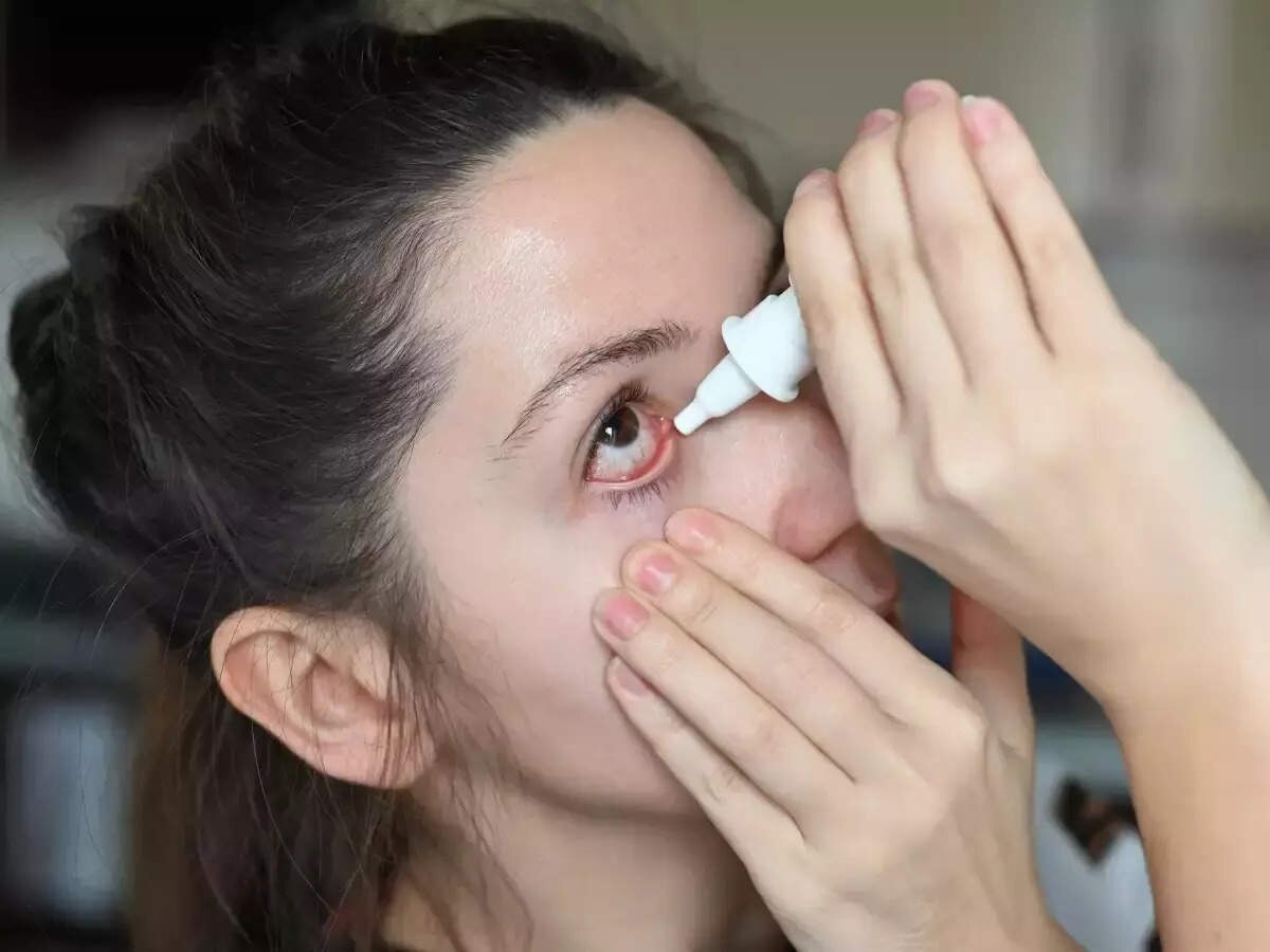 Eye Flu Remedies: डॉ. ने बताया, अगर इन चीजों का रखेंगे ख्याल तो दूर तक नहीं भटकेगा आई-फ्लू