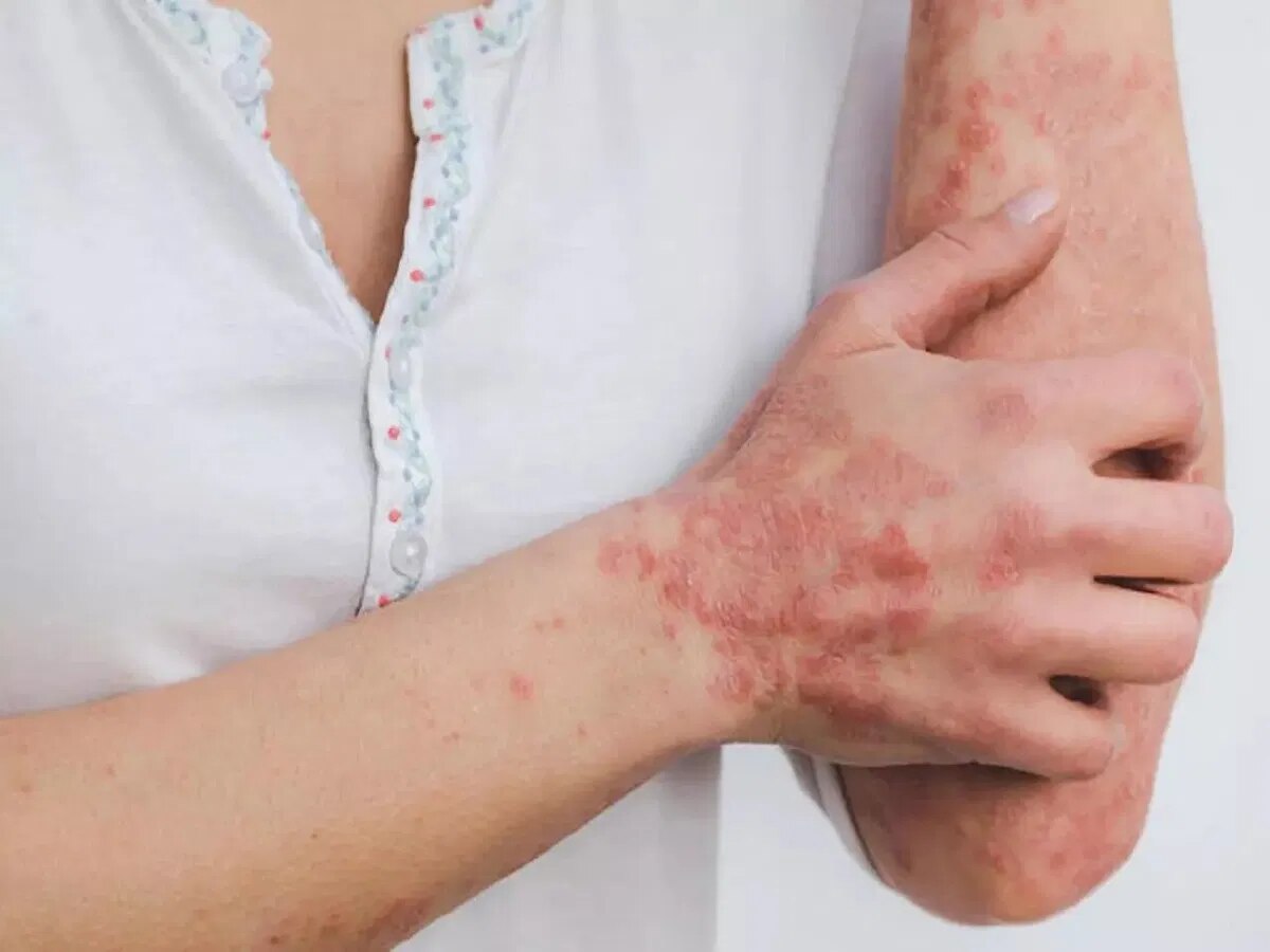 Fungal Infection: आई फ्लू के साथ बढ़ने लगा है फंगल स्किन इंफेक्शन, ये हैं लक्षण और इस तरह करें घर में इलाज