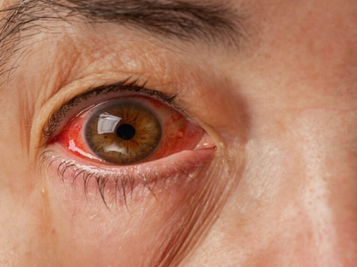 natural-treatment-for-conjunctivitis-try-these-5-effective-home