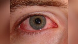 Eye Flu: क्या है पिंक और ड्राई आंखों में अंतर? जानिए कैसे करें आई फ्लू से बचाव