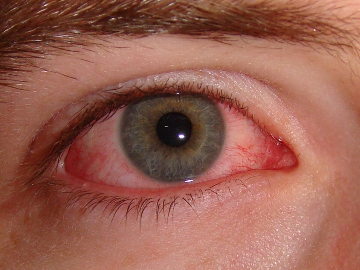 Eye Flu: क्या है पिंक और ड्राई आंखों में अंतर? जानिए कैसे करें आई फ्लू से बचाव