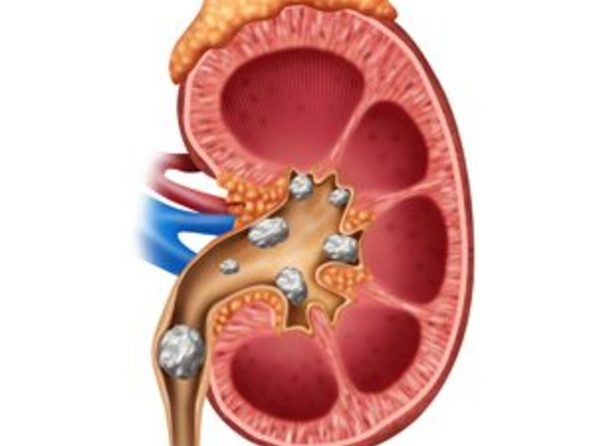 Ayurvedic treatment for kidney stone: रोजाना करें इन आयुर्वेदिक चीजों का सेवन जल्द मिलेगा किडनी स्टोन से छुटकारा 