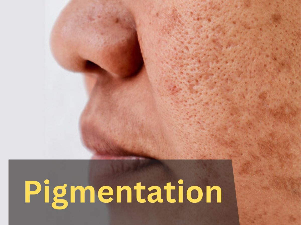 How To Get Rid Of Pigmentation on Your Face using Almond Oil Skin