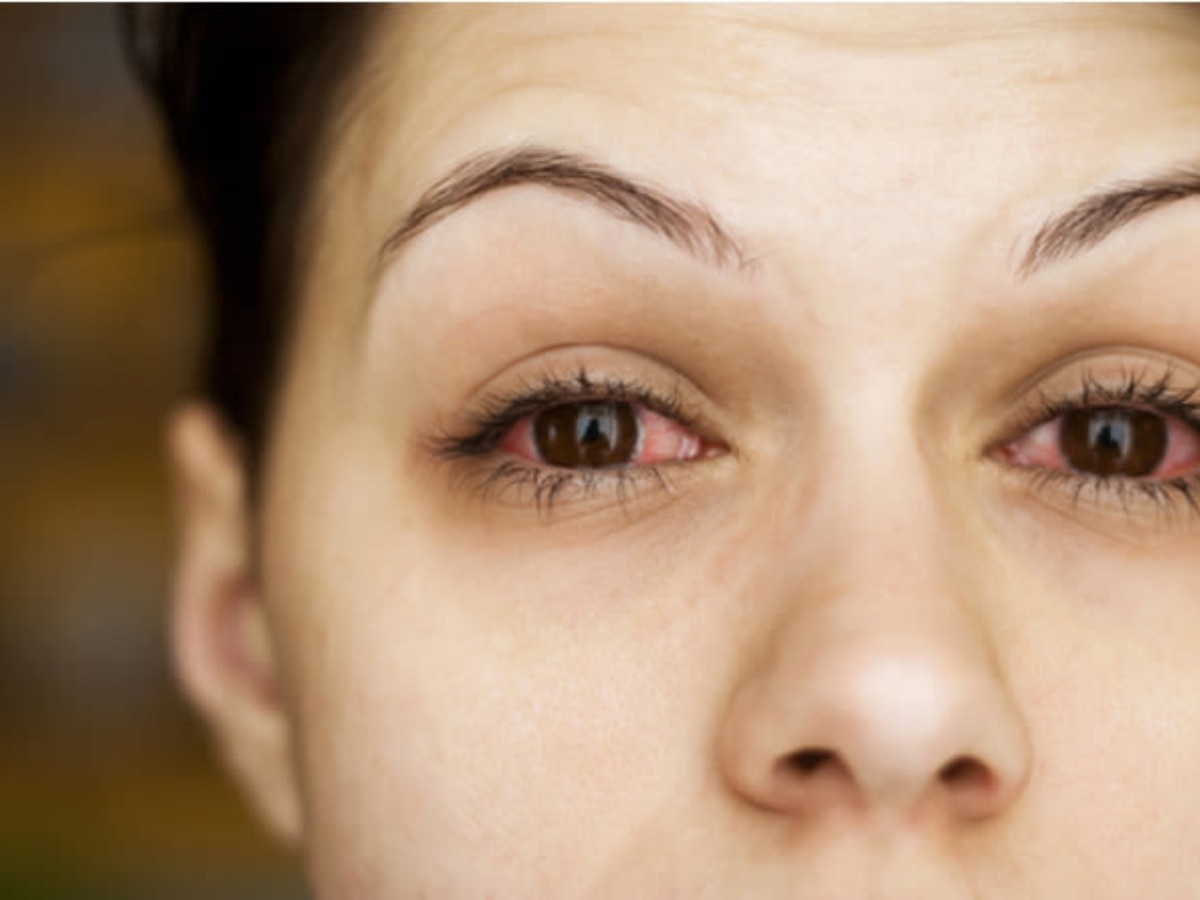 What to eat during Eye Infection: आई फ्लू में जरूर करें इन खास चीजों का सेवन 