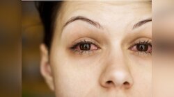 What to eat during Eye Infection: आई फ्लू में जरूर करें इन खास चीजों का सेवन 