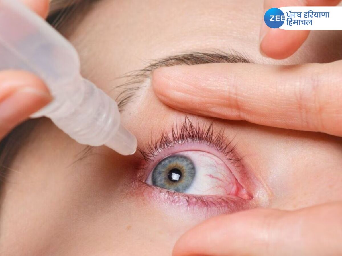 Eye flu cases in Mohali: ਮੁਹਾਲੀ ਤੋਂ ਆਈ ਫਲੂ ਦੇ ਰੋਜ਼ਾਨਾ 300 ਤੋਂ ਵੱਧ ਮਾਮਲੇ ਕੀਤੇ ਜਾ ਰਹੇ ਦਰਜ, ਡੇਰਾਬੱਸੀ ਬਣਿਆ ਹੌਟਸਪੌਟ 