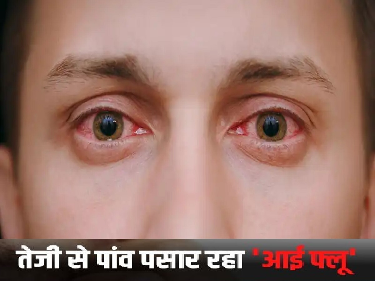 Eye Flu Cases: बिहार में तेजी से पांव पसार रहा 'आई फ्लू', बच्चों से लेकर बुजुर्ग तक हो रहे शिकार 