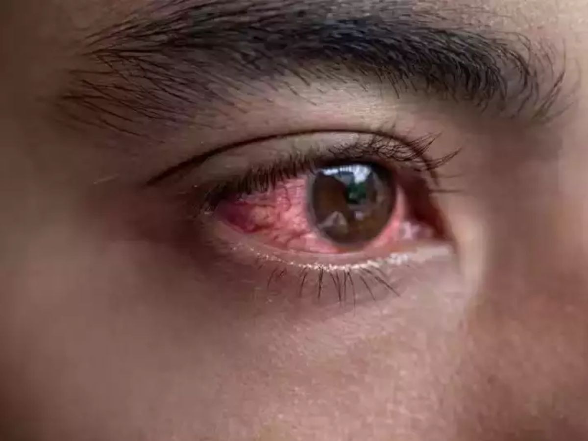 eye-flu-myth-busters-does-eye-flu-spread-by-looking-in-hindi-kya-dekhne