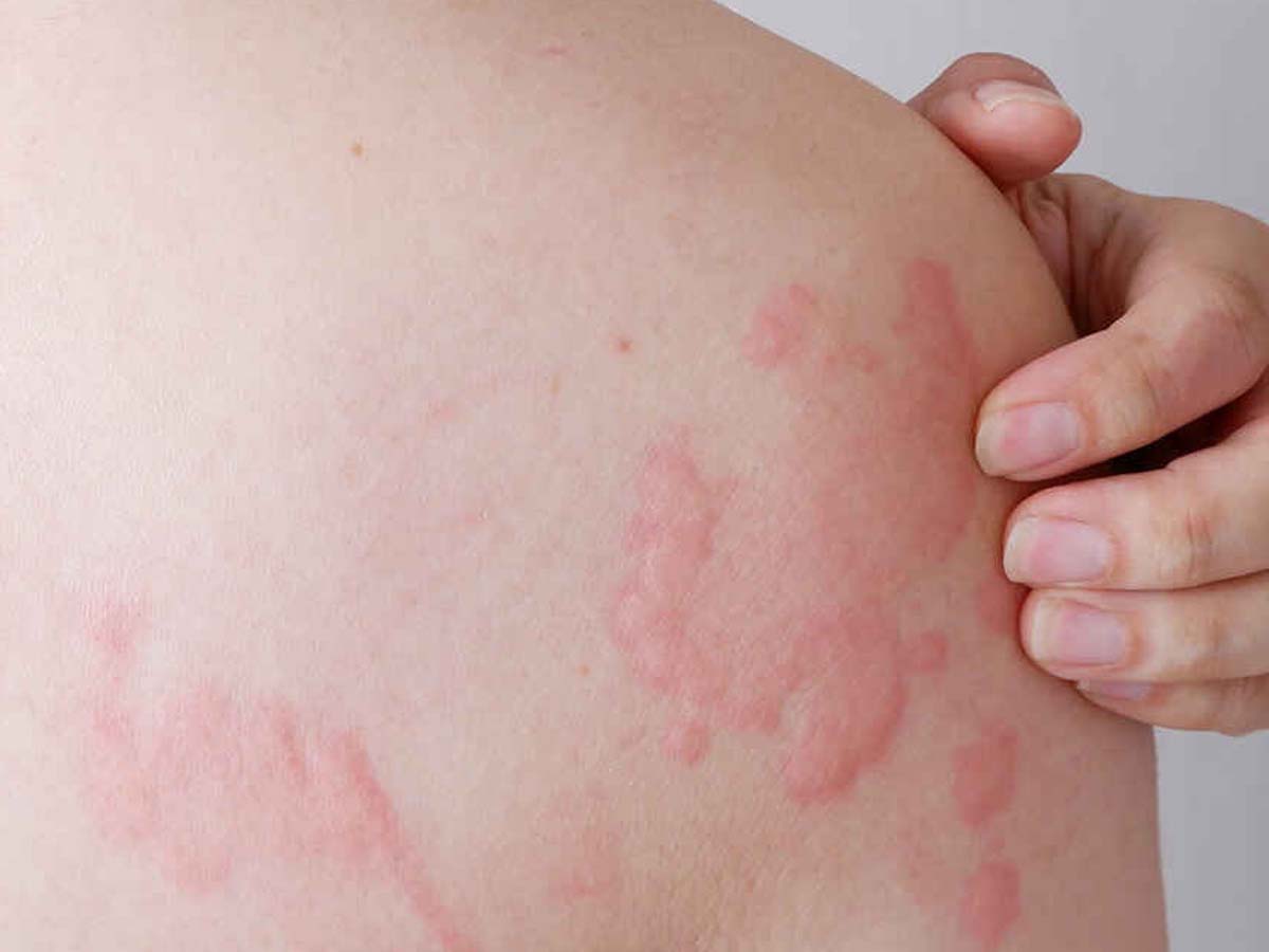 स्किन पर लाल रंग के रैशेज