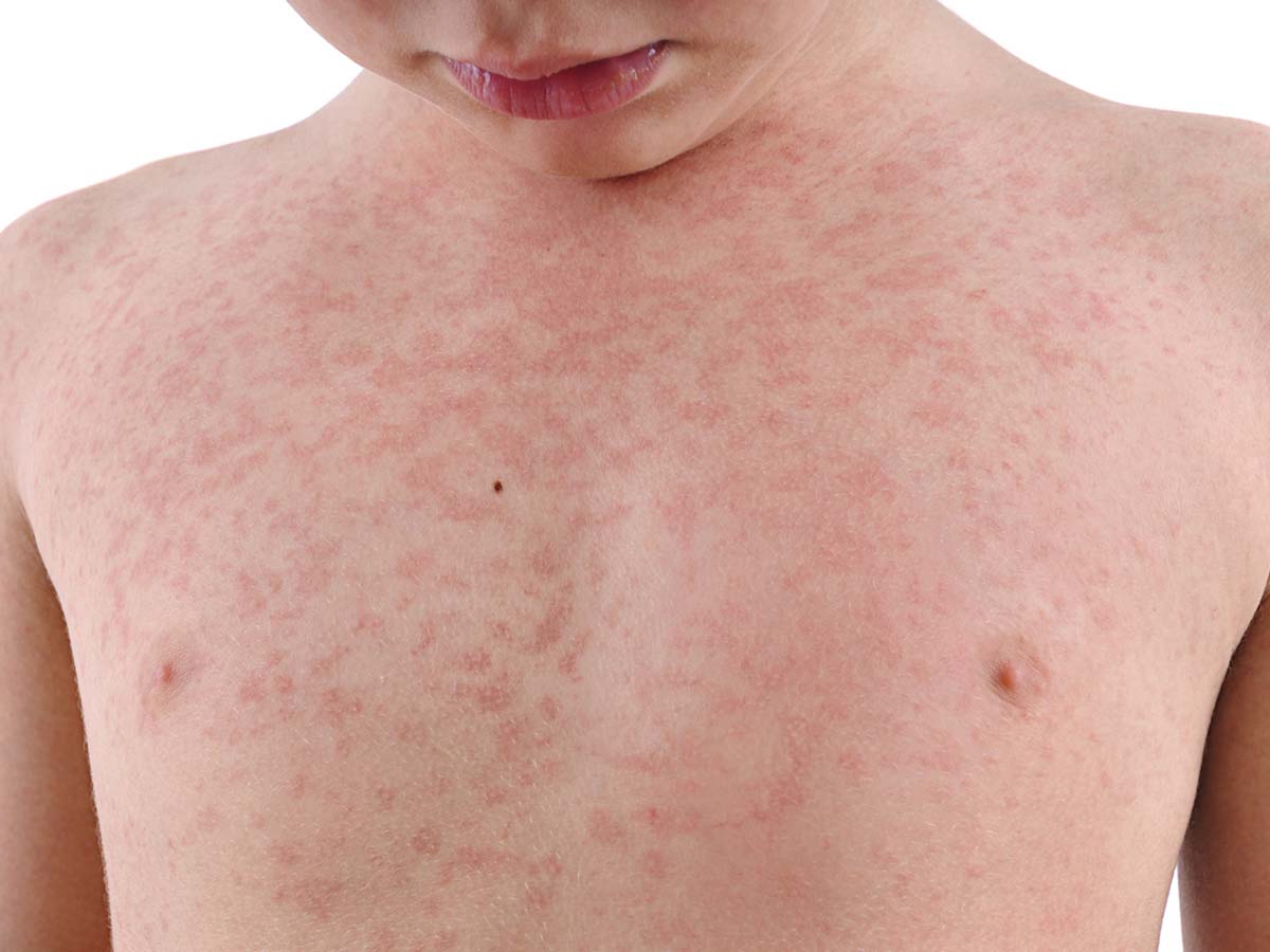 रिंगवर्म से होने वाली एलर्जी