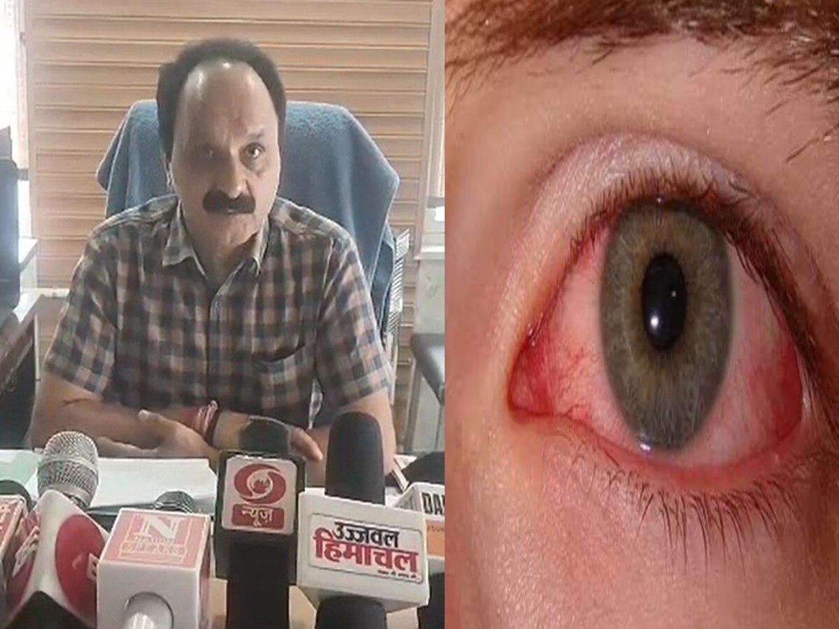Eye Flu: हमीरपुर में बढ़ने लगे आई फ्लू के मामले, जिला स्वास्थ्य विभाग ने जारी किए निर्देश