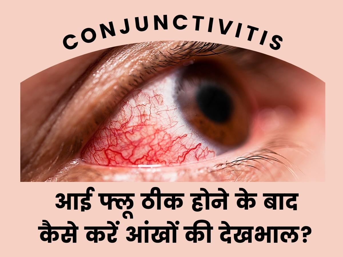 Conjunctivitis Eye Flu: आई फ्लू ठीक होने के बाद भी आंखों को पहुंच सकता है नुकसान! ये लापरवाही बरतना पड़ेगा महंगा