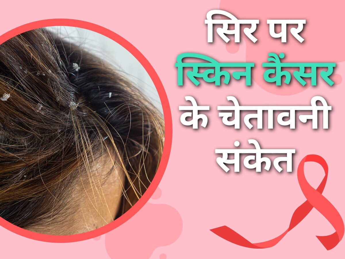 Skin Cancer: सिर से भी मिलते हैं स्किन कैंसर के चेतावनी संकेत, डैंड्रफ समझने की न करें भूल