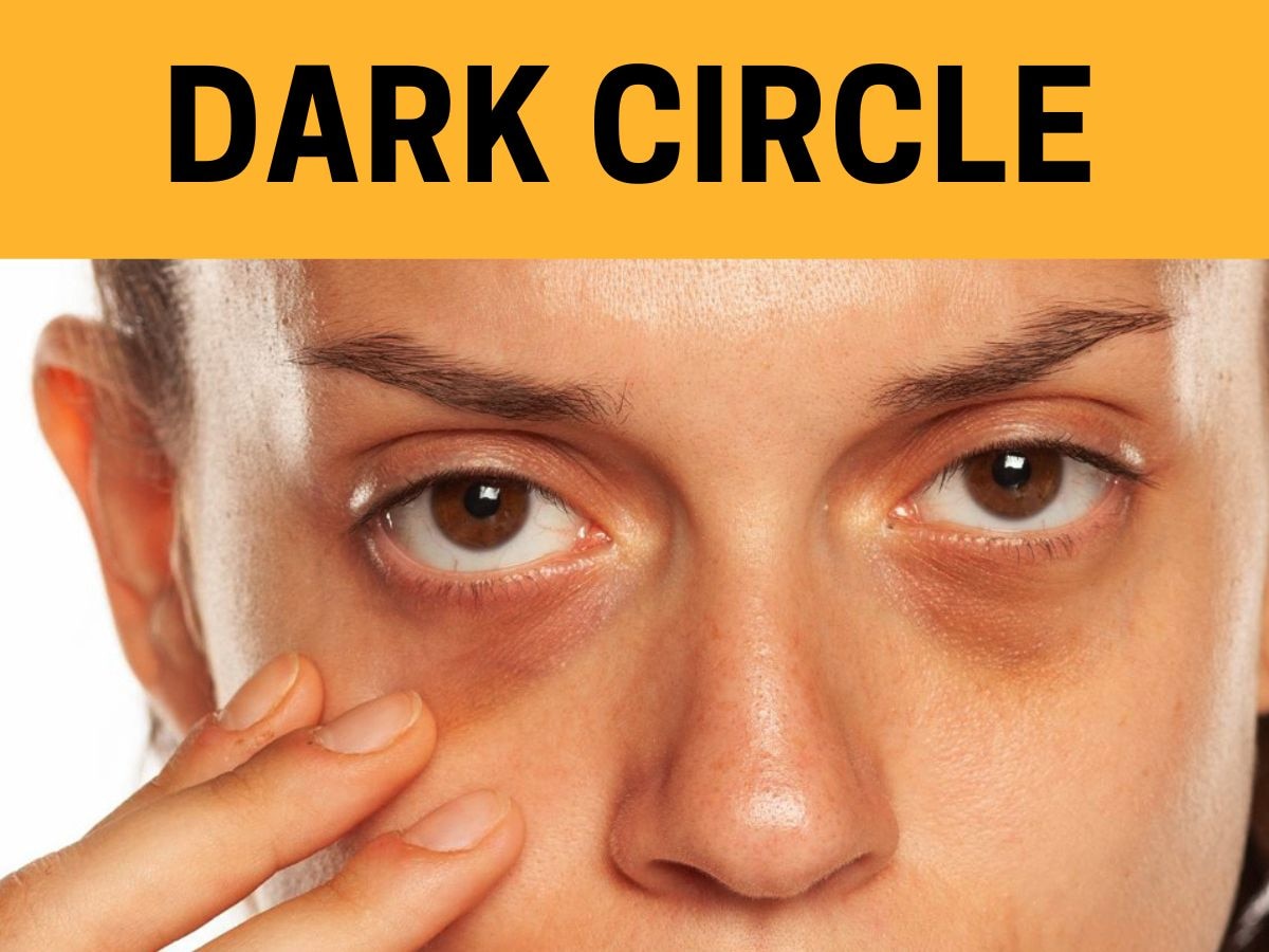 Dark Circle: आंखों के पास काले घेरे का मिट जाएगा नामोनिशान, चेहरा हो जाएगा चांद सा रोशन
