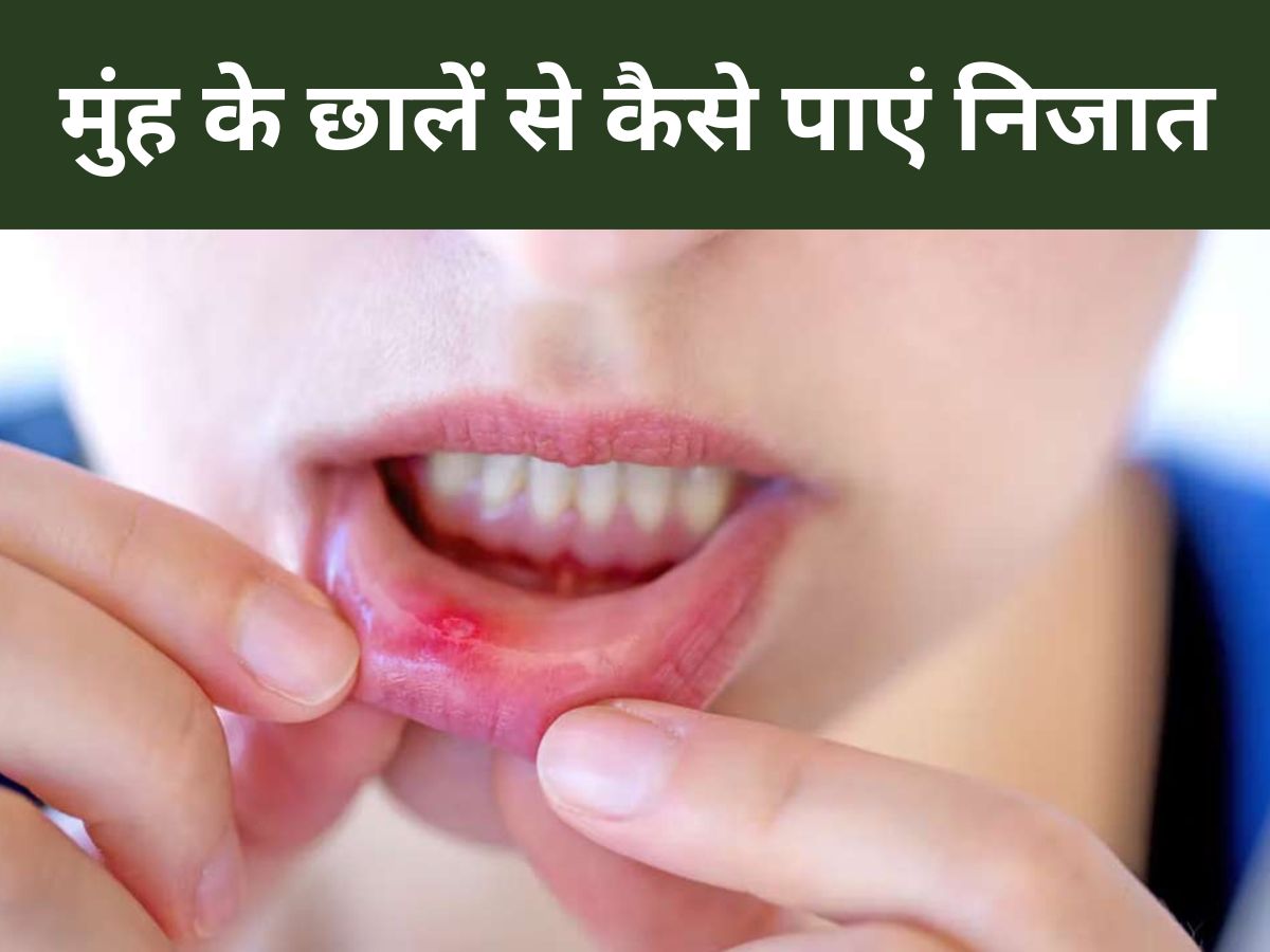 How To Get Rid Of Mouth Ulcers Home Remedies Coconut Oil Cardamom
