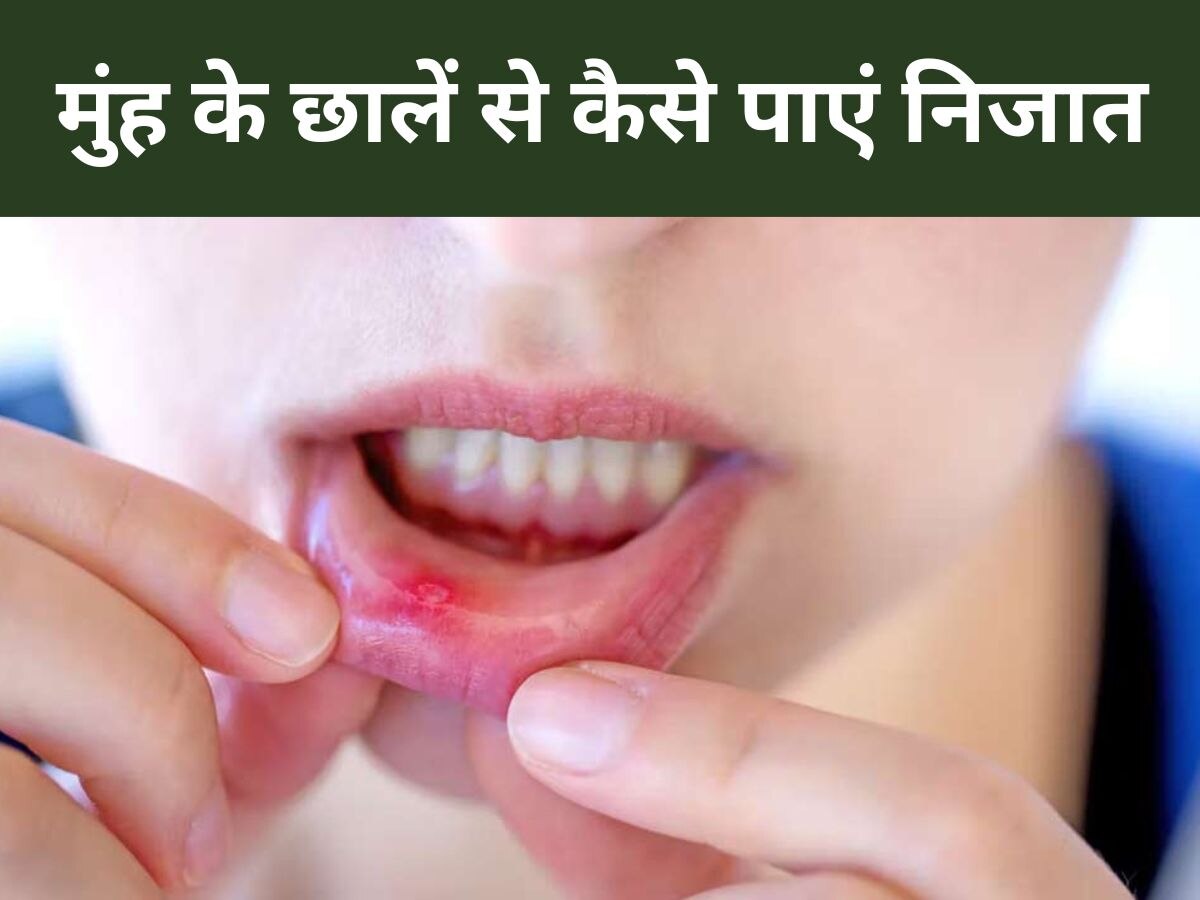 Mouth Ulcers: मुंह के छालों की वजह से भोजन करना हुआ मुश्किल? जानिए कैसे पाएं चुटकियों में आराम