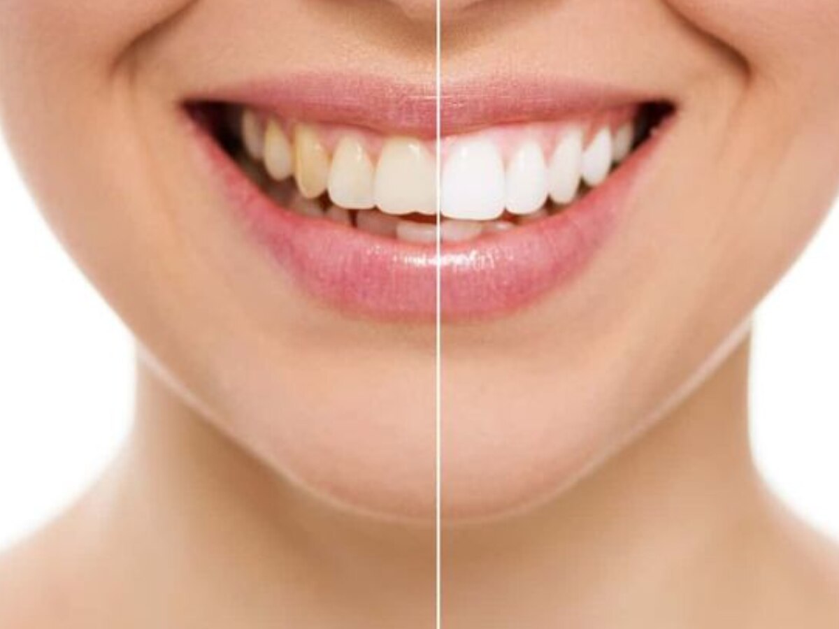 Remedies for teeth: चांदी की तरह चमक जाएंगे दांत, आजमा कर देखें ये घरेलू नुस्खें