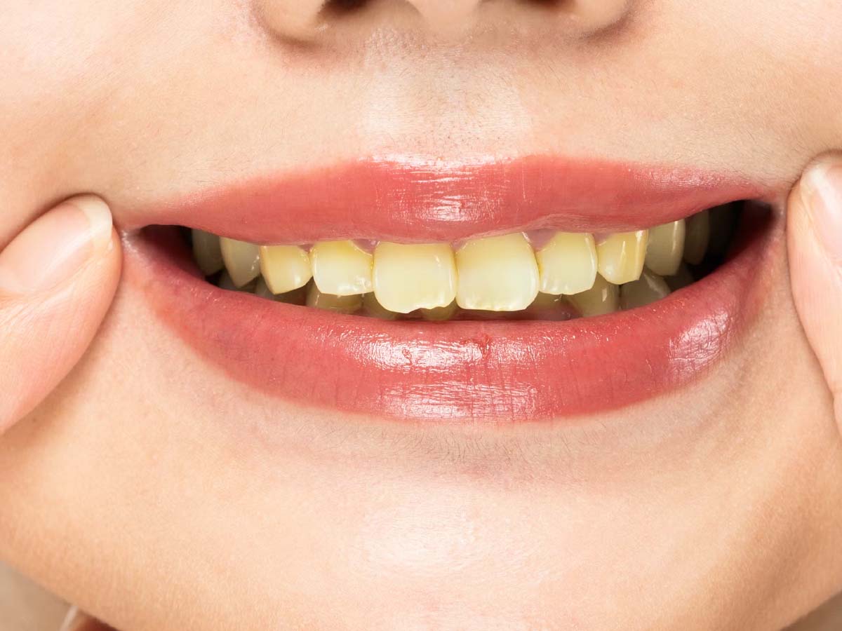 Teeth Whitening use lemon baking soda neem datoon to white the teeth