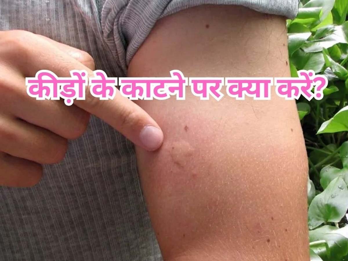 Home Remedies for Insect Bites: बरसात में कीड़े- मकोड़ों के काटने से बुरा हाल, आजमा लें ये 4 देसी नुस्खे; तुरंत मिल जाएगा आराम