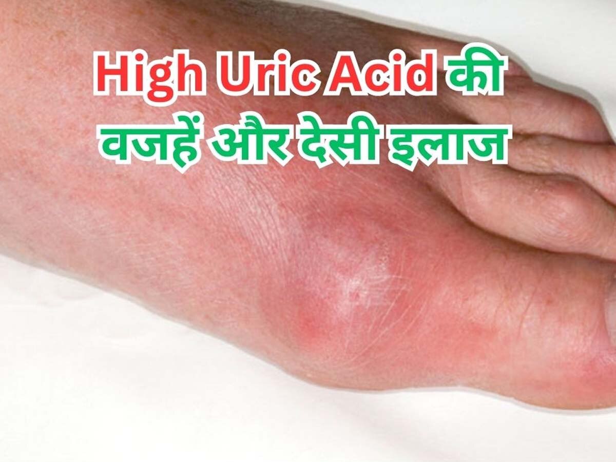  High Uric Acid: High Uric Acid होने पर बढ़ जाता है पैरों में सूजन और हड्डियों में दर्द, घर बैठे राहत पाने के लिए आजमा लें ये देसी नुस्खे 