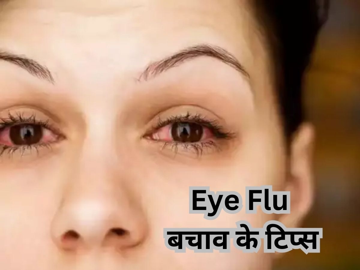 Eye Flu Home Remedy: आई फ्लू से बचने के लिए कर सकते हैं आयुर्वेदिक उपाय, यहां जानिए 