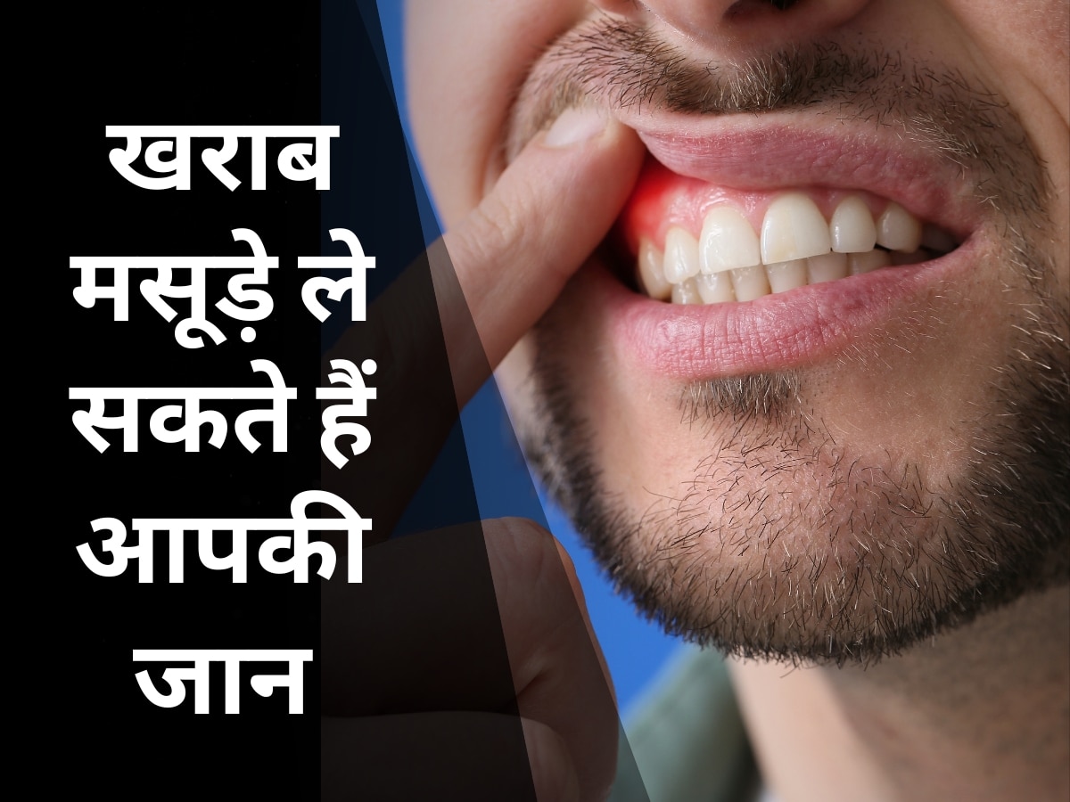 Sore gum: खराब मसूड़ों से इस बीमारी का अधिक खतरा, हर साल होती है 1.5 करोड़ से ज्यादा लोगों की मौत