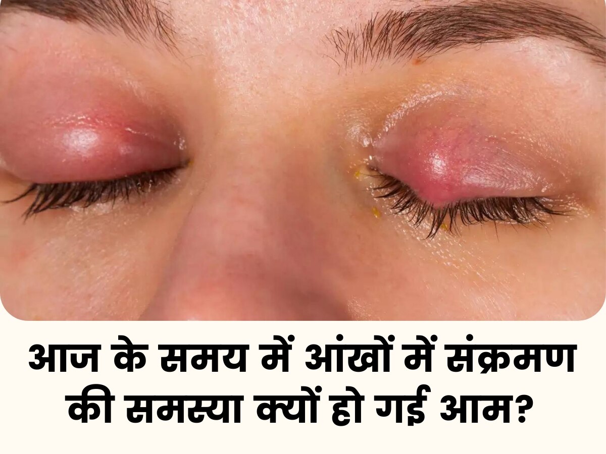 Eye Infection: आंखों में बढ़ते संक्रमण के पीछे क्या है कारण? भारत में स्थिति गंभीर!