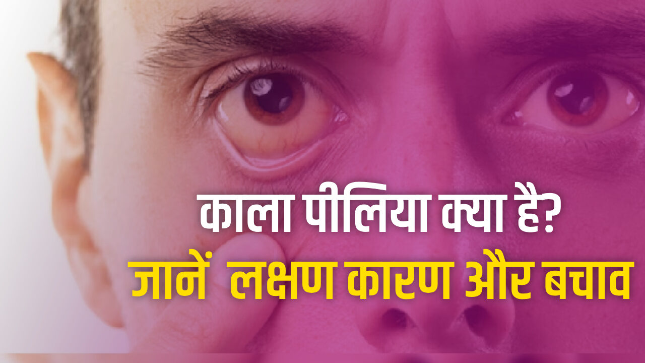 what is black jaundice know home remedies kala piliya bimari kya hai