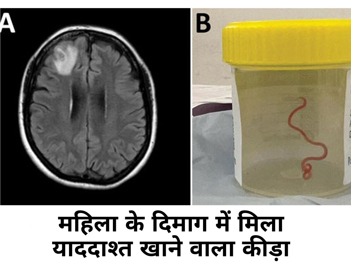 OMG! महिला के दिमाग में मिला याददाश्त खाने वाला कीड़ा, दुनिया का पहला केस देख डॉक्टर हुए हैरान