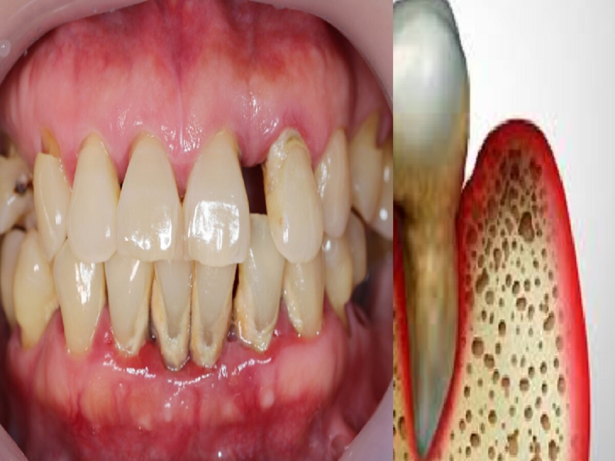 Tooth Cavity: मात्र 10 रुपये में दूर करें मसूड़ों की सड़न ! इस उपाय से जल्द मिलेगा छुटकारा