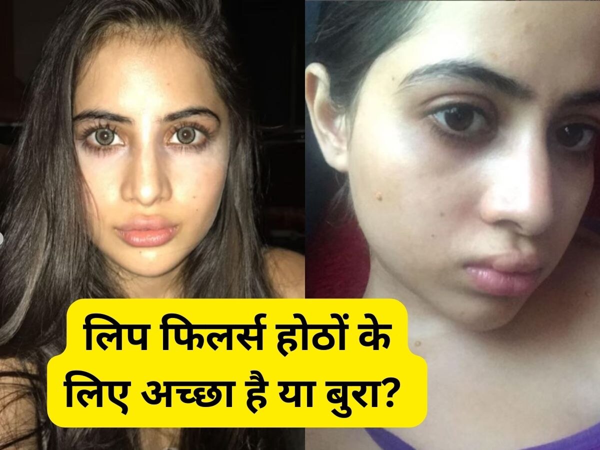 Urfi Javed के बाद इस एक्ट्रेस ने कराया Lip Fillers, जानें कितना दर्दनाक है इसका पूरा प्रोसेस और क्या हैं इसके नुकसान