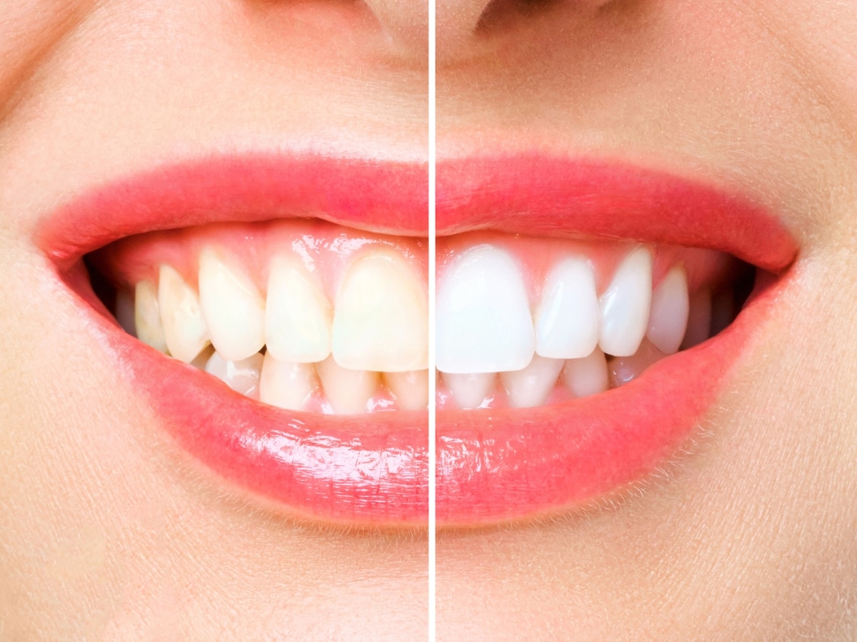Teeth Whitening: दिन में दो बार ब्रश करने के बाद भी नहीं जा रहा दांतों से पीलापन? अपनाएं ये देसी नुस्खा, मोतियों की तरह चमक उठेंगे दांत