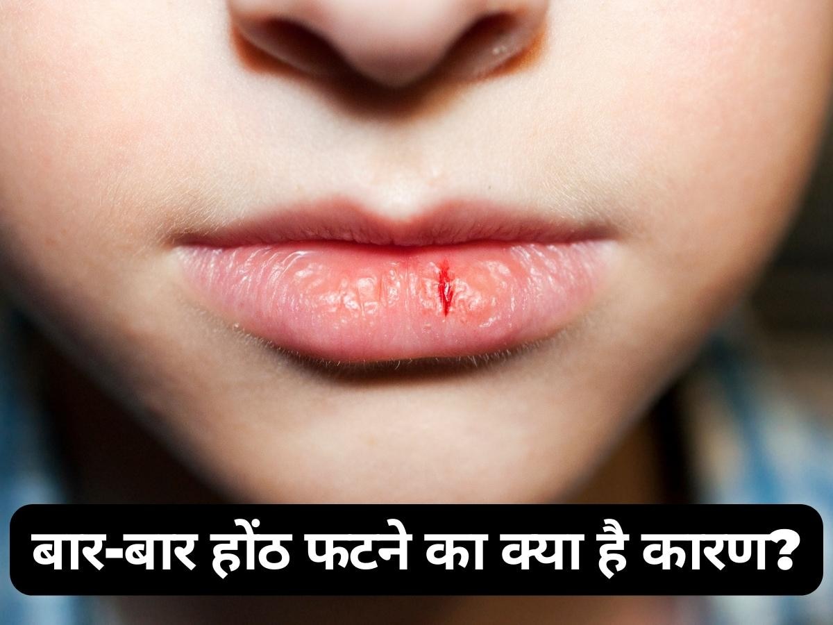 Cracked Lips: बार-बार होंठ फटने का क्या है कारण? कहीं इन बीमारियां का खतरा तो नहीं