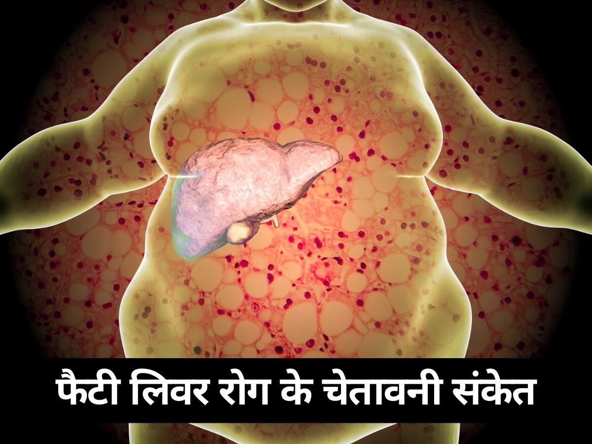 Fatty Liver Disease: फैटी लिवर रोग के नाखून और आंखों पर इस तरह मिलते हैं चेतावनी संकेत, इग्नोर करना पड़ेगा महंगा!