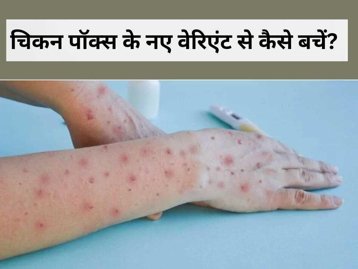 Chickenpox Clade 9: भारत में आफत मचाने आया चिकनपॉक्स का नया वेरिएंट, बच्चों को बना रहा निशाना, ऐसे करें बचाव