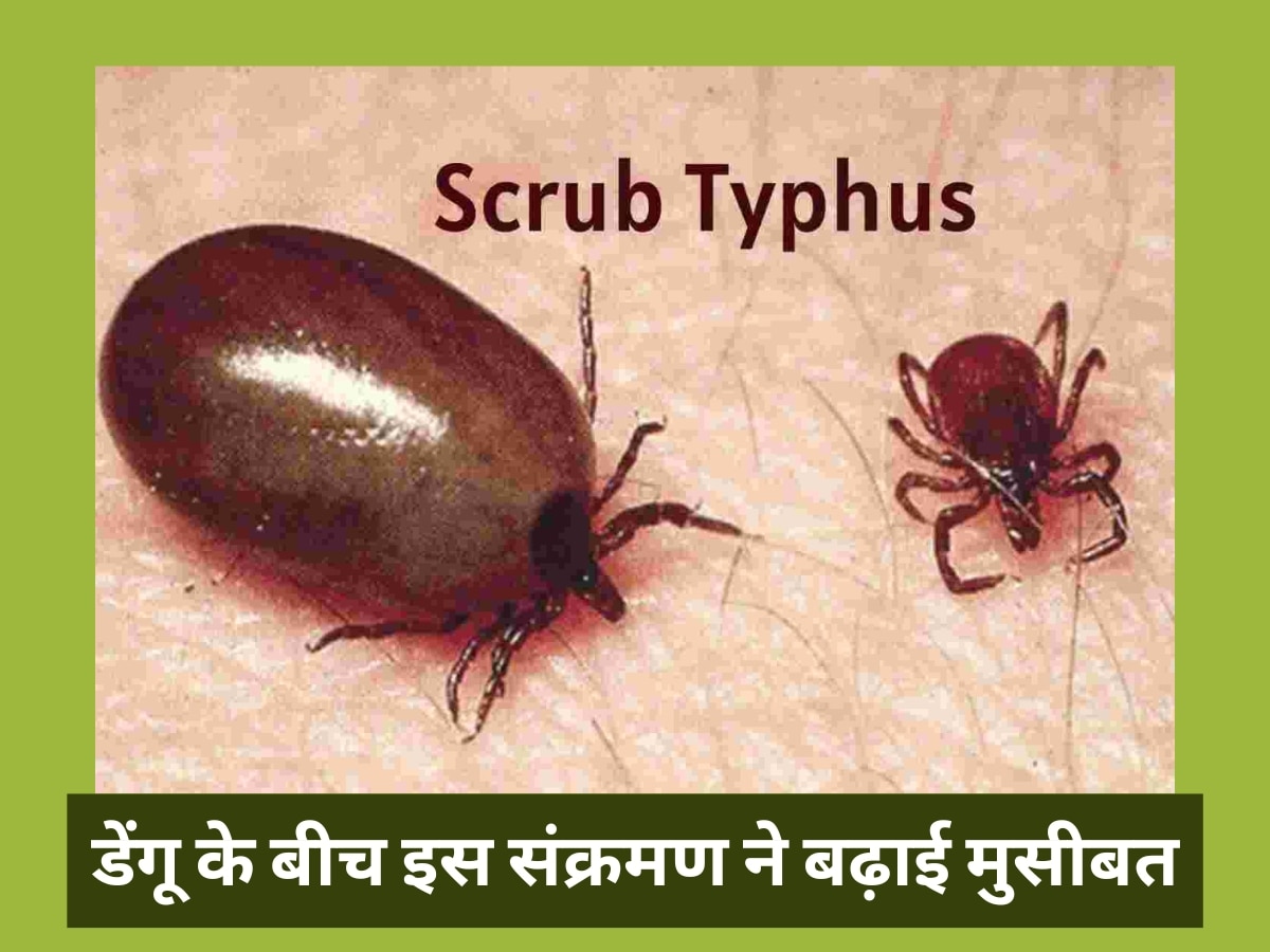 Scrub Typhus: डेंगू के बीच इस जानलेवा संक्रमण ने बढ़ाई लोगों की मुसीबत, डॉक्टरों ने जारी की चेतावनी