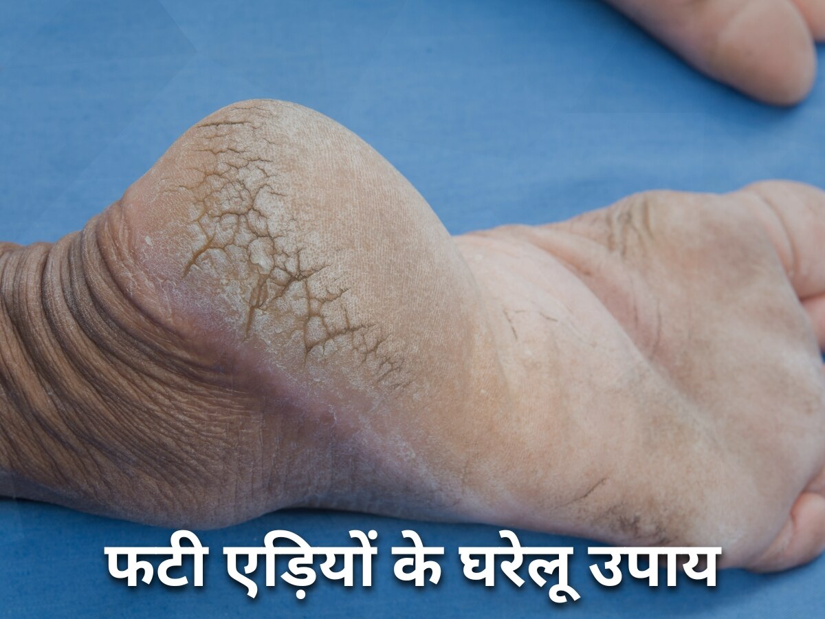 Cracked Heels Remedies: अब फटी एड़ियों को कहें गुड बाय, इन घरेलू उपायों से पैरों को बनाए कोमल