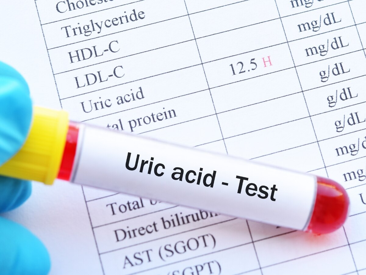 दवाई लेने के बाद भी कम नहीं हो रही Uric Acid, रूटीन में शमिल करें 4 एक्सरसाइज; हफ्ते भर में दिखने लगेगा असर