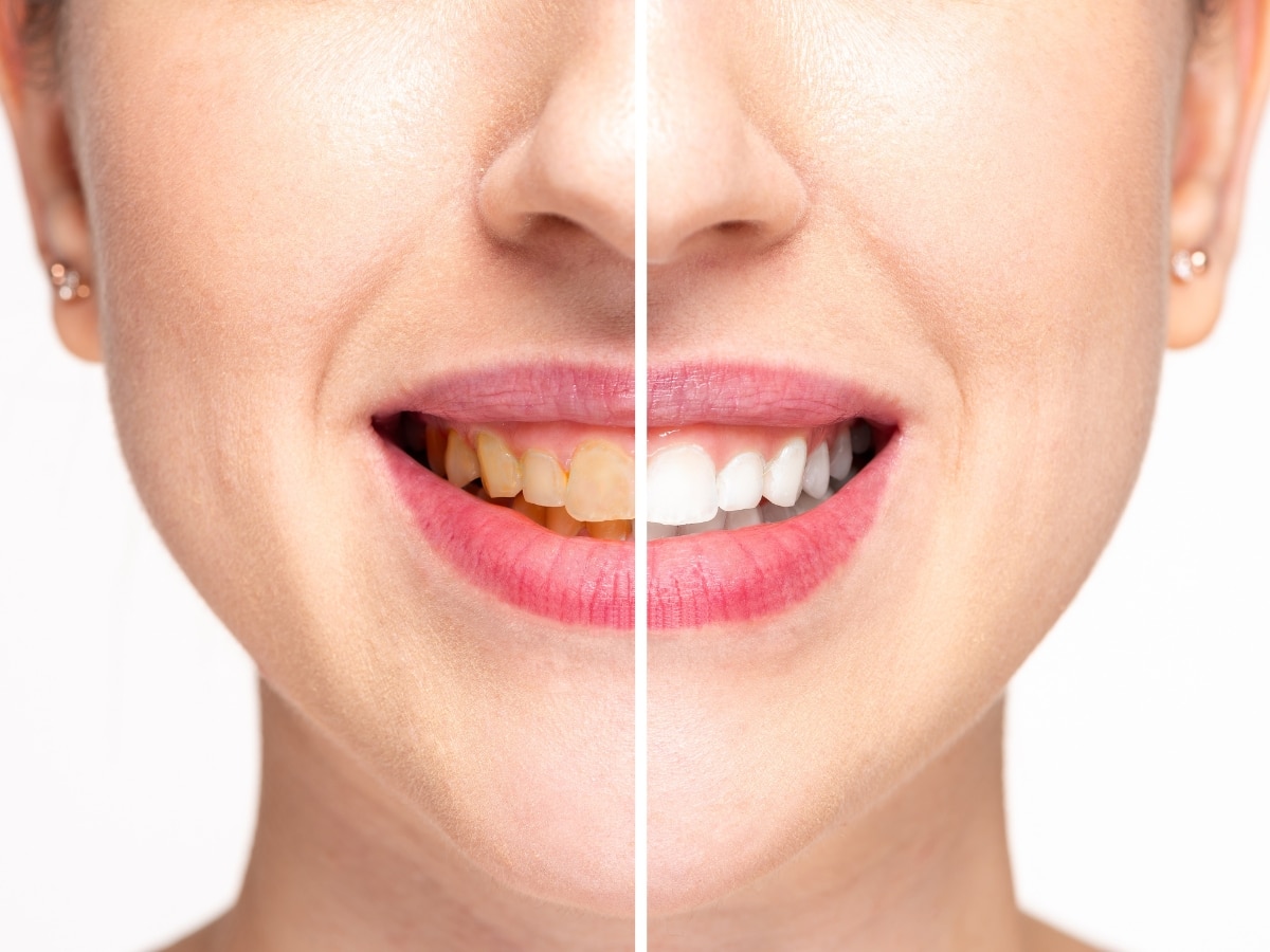 Natural Teeth Whitening: दांतों से पीलापन हटाएंगे ये 5 घरेलू उपाय, मोती की तरह चमकने लगेंगे आपके दांत
