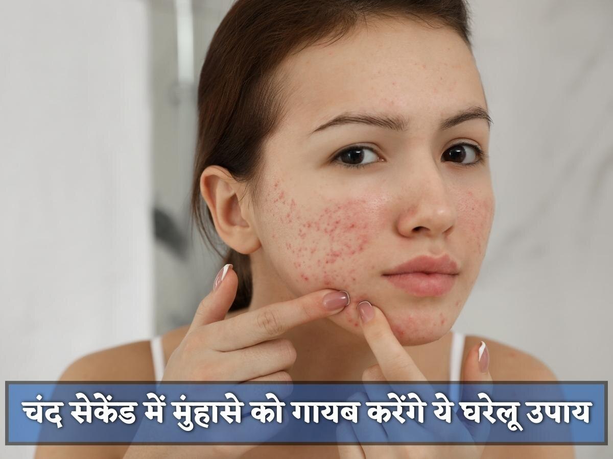 Acne Removal: चंद सेकेंड में चेहरे से गायब हो जाएंगे मुंहासे, अपनाएं ये घरेलू उपाय