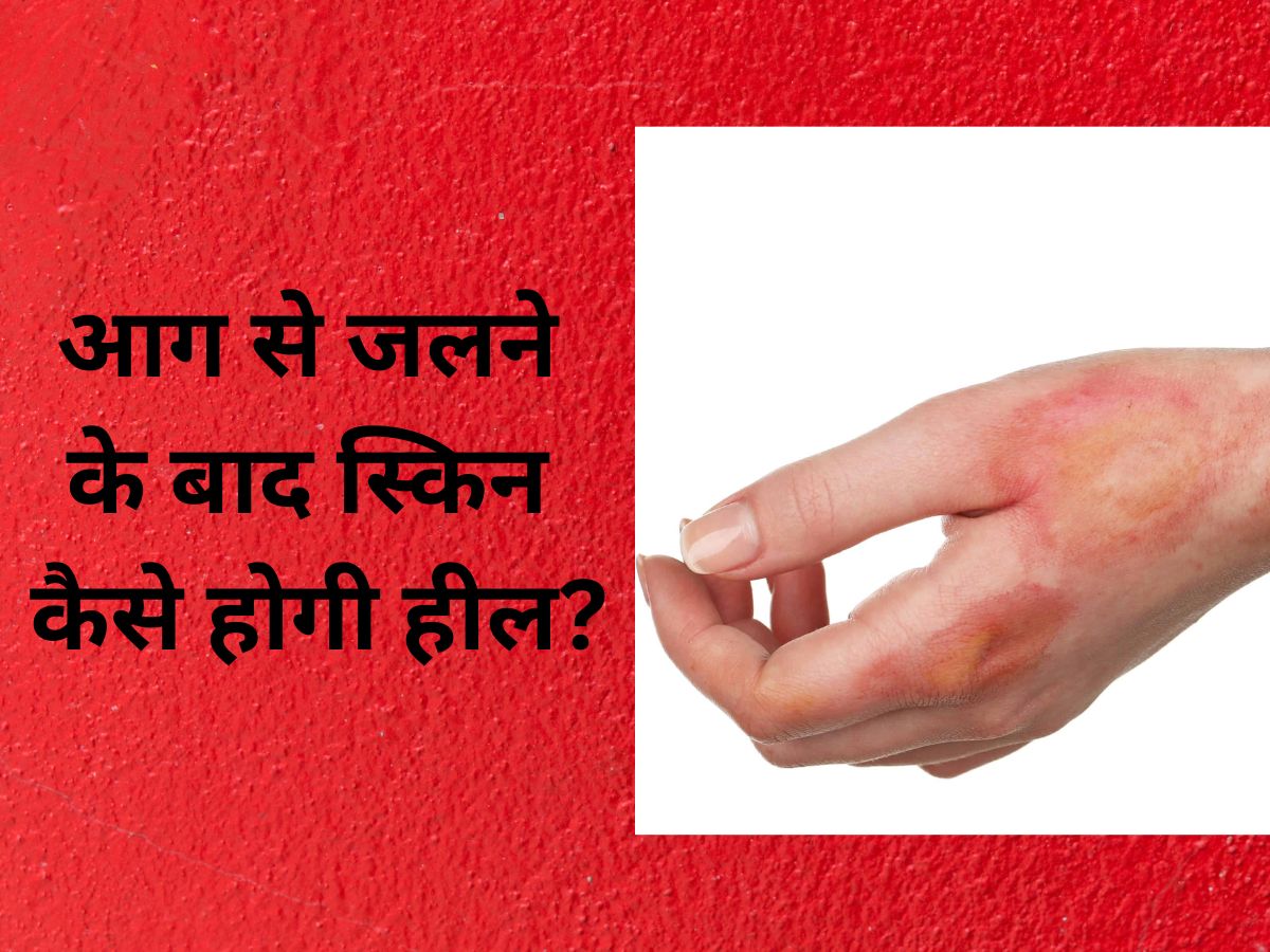 How do I heal a Skin Fire burn quickly Home Remedies Aaj Se Jalne Par
